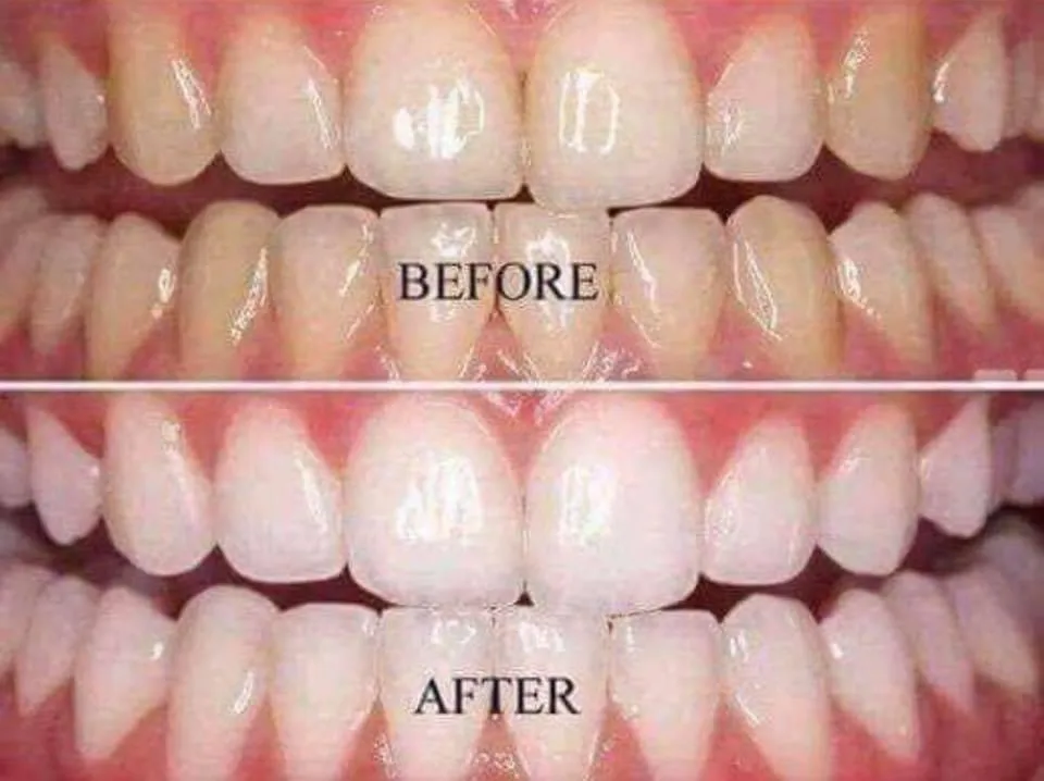 BEST WHITENING TOOTHPASTE ON THE MARKET